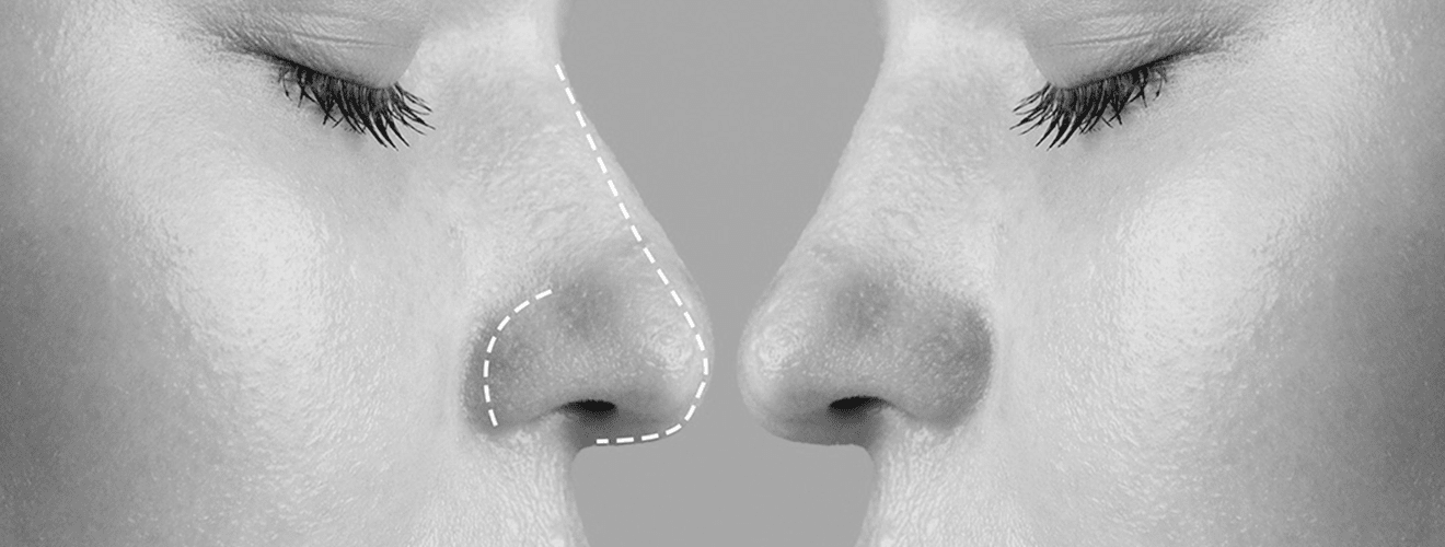 Before and after concept for rhinoplasty (nose surgery) illustrating dorsal hump removal and nasal tip refinement planning.