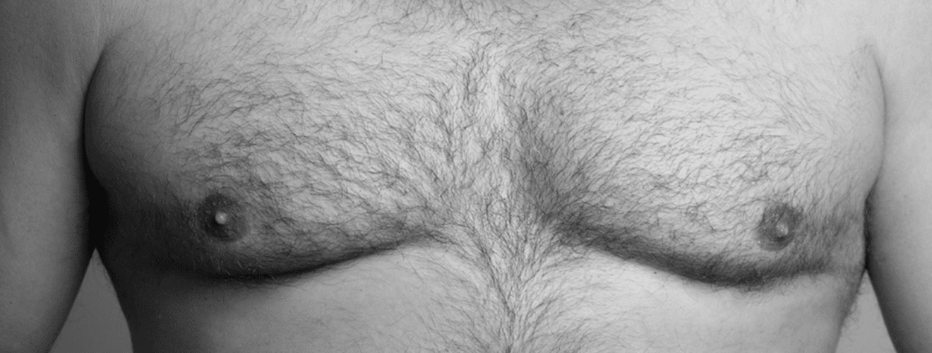 Close-up of a man's chest with gynecomastia, showing enlarged male breasts before surgery.