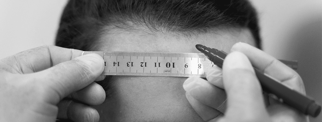 Precise measurement and planning on forehead with ruler for natural hairline design before hair transplant surgery.