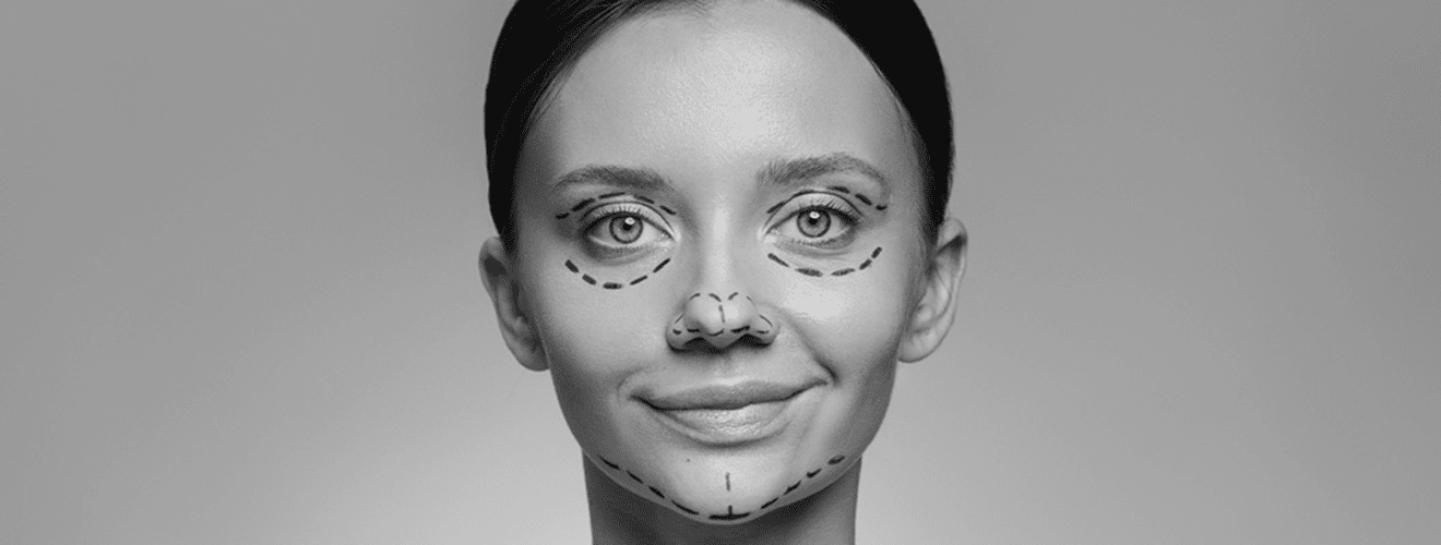Surgical markings on woman's face indicating target areas for facial fat grafting (fat transfer) planning.