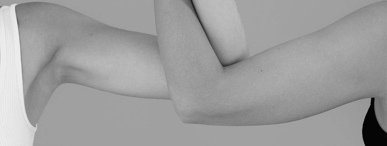 Arm showcasing a firm, smooth, and aesthetic contour achieved with arm lift (brachioplasty) surgery.
