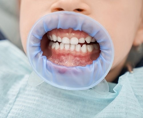 Pedodonti-Çocuk-Diş-Hekimliği