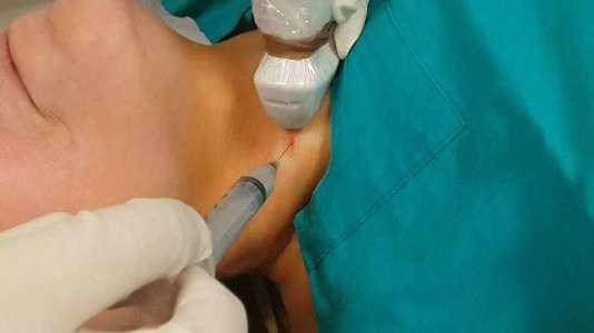 Tiroid İnce İğne Aspirasyon Biyopsisi 1