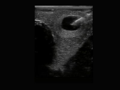 Tiroid İnce İğne Aspirasyon Biyopsisi 2