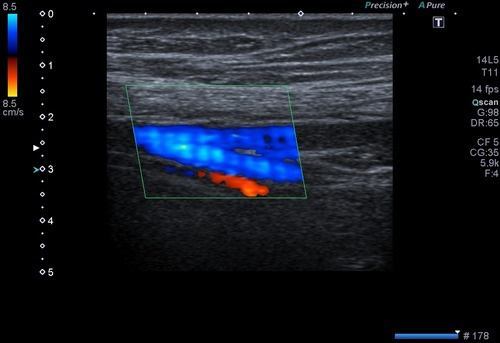 Ekstremite-Venöz-Doppler-Ultrason