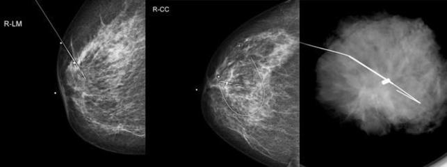 MEMEDE MAMOGRAFİ YA DA ULTRASON İLE İŞARETLEME