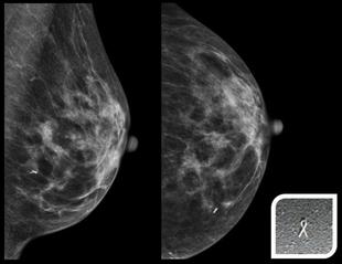 MEMEDE MAMOGRAFİ YA DA ULTRASON İLE İŞARETLEME 2