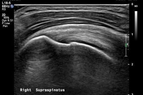 Eklem Ultrasonografisi