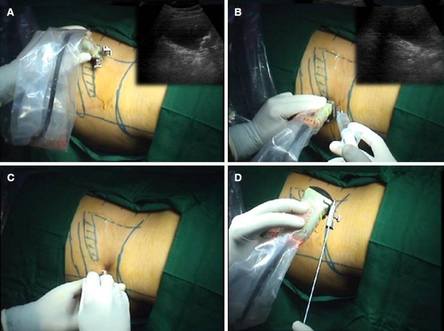 Böbrek içersine Katater Yerleştirilmesi 2