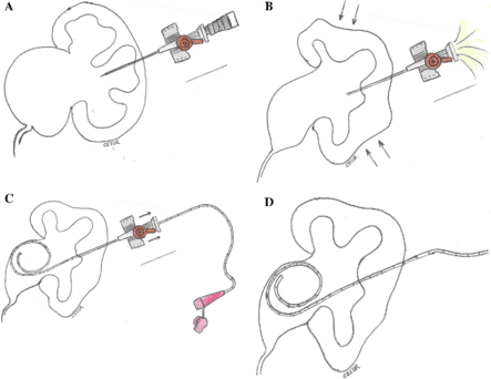Böbrek içersine Katater Yerleştirilmesi 1