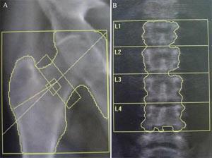Kemik Mineral Dansitesi 2
