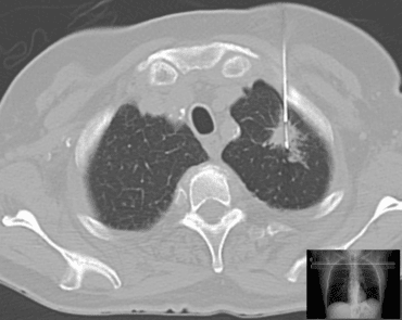 Kitleye Yönelik Tru Cut Kalın İğne Biyopsi 2