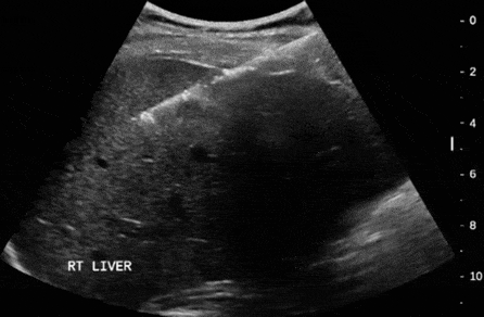 Kitleye Yönelik Tru Cut Kalın İğne Biyopsi 1
