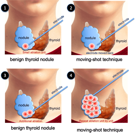 Tiroid Nodüllerinde Radyofrekans Ablasyon Tedavisi 1