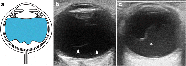 Orbita Ultrasonografisi