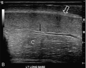 Penil Renkli Doppler Ultrason 2