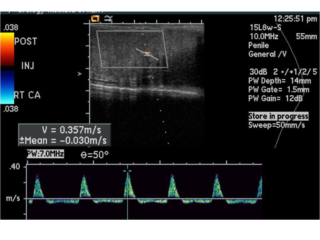 Penil Renkli Doppler Ultrason 3