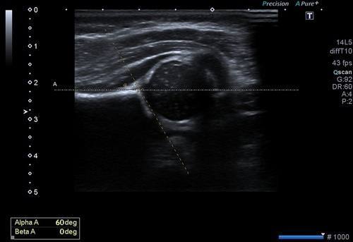 Pediatrik-Kalça-Ultrasonu