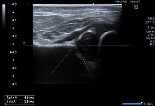 Pediatrik-Kalça-Ultrasonu-2
