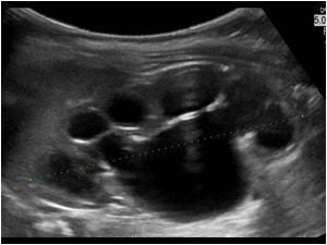 PEDAİTRİK KARIN ULTRASONU 2