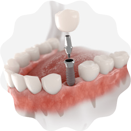 Zahnimplantate