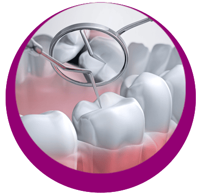 INLAYS – OBTURATION DENTAIRE
