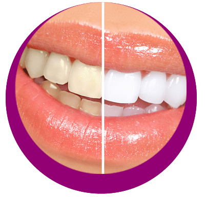 BLANCHIMENT DES DENTS