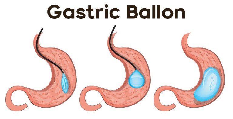 Balón Gástrico-Estambul
