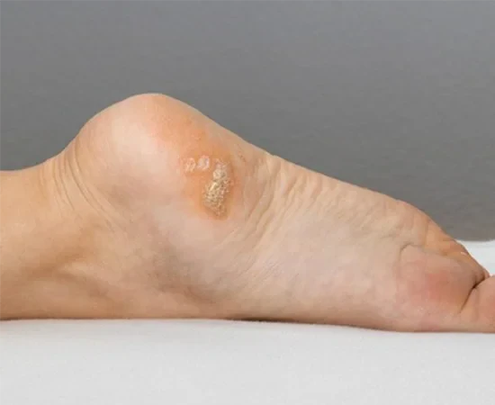 Ayak-Tabaninda-Sigil-2