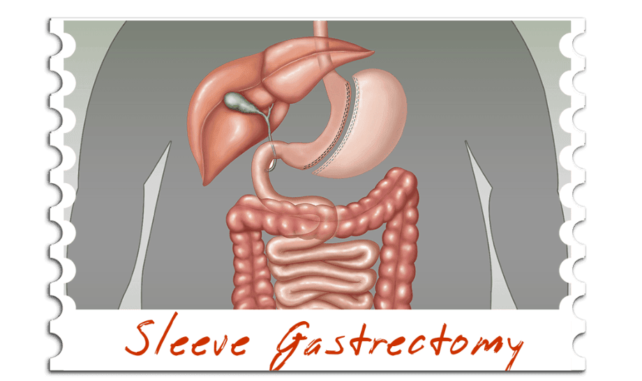 Sleeve Gastrectomy
