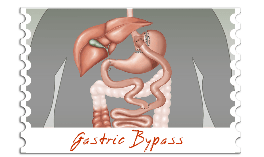 Gastric Bypass