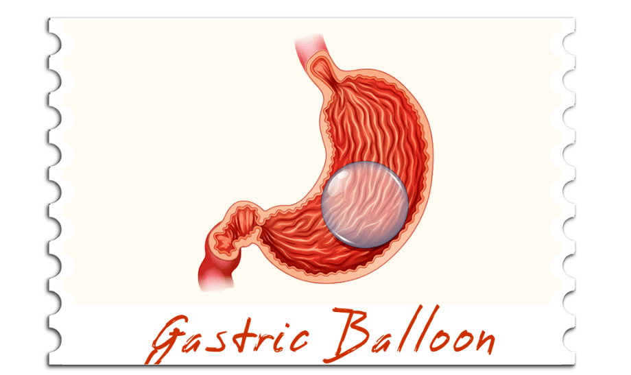 Gastric Balloon
