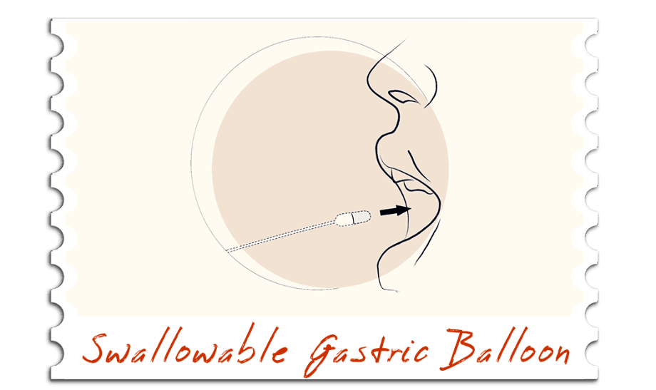Swallowable Gastric Balloon