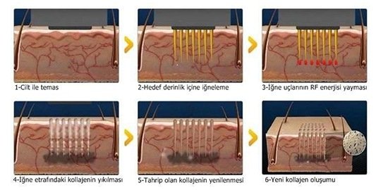 ellisys fractional plus uygulama
