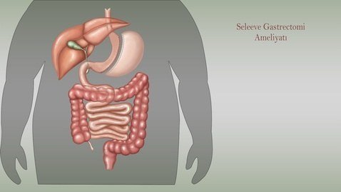 sleeve-gastrectomy.jpg