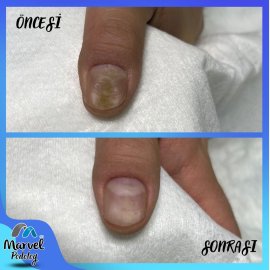 Medikal Tırnak Bakımı