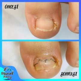 Batık Tırnak Bakımı