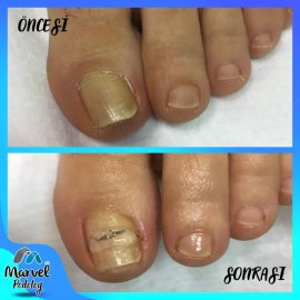 Batık Tırnak Bakımı