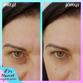 Kırışıklık Giderme