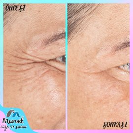 Kırışıklık giderme