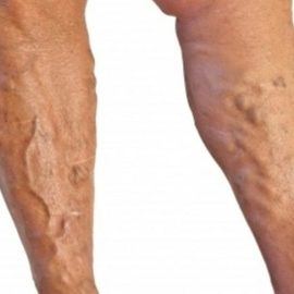 may turner sendromu (damar damar üstüne binmesi)