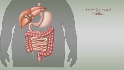 sleeve-gastrectomy.jpg