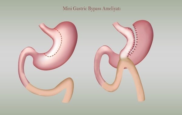 mini gastric bypass