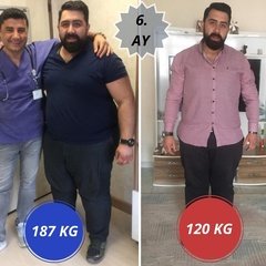 Adipositaschirurgie / Clinic Antalya in der Türkei