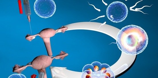 微芯片体外受精(IVF)