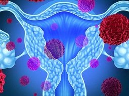 Jinekolojik Onkoloji