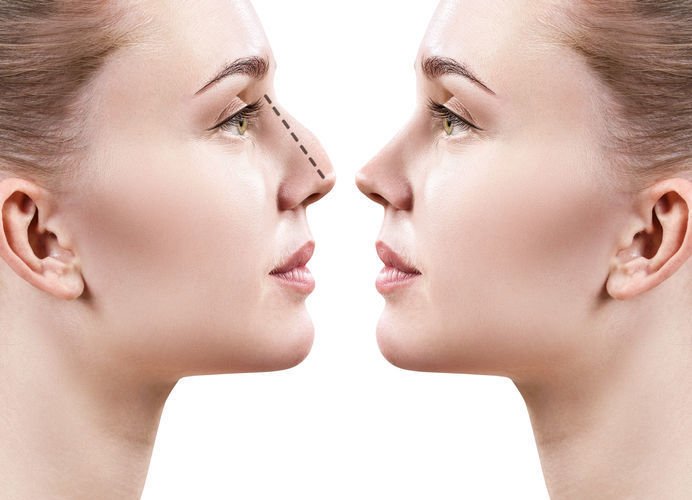 Rhinoplastik