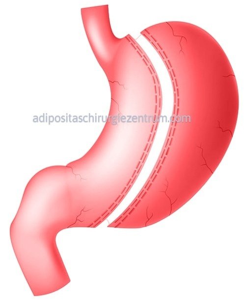 SCHLAUCHMAGEN-OPERATION