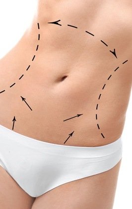 Bauchdeckenstraffung