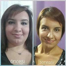 VORHER NACHER BILDER DER PATIENTEN